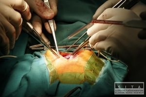 Kyfoplastika pomáha liečiť chrbticu poškodenú osteoporózou